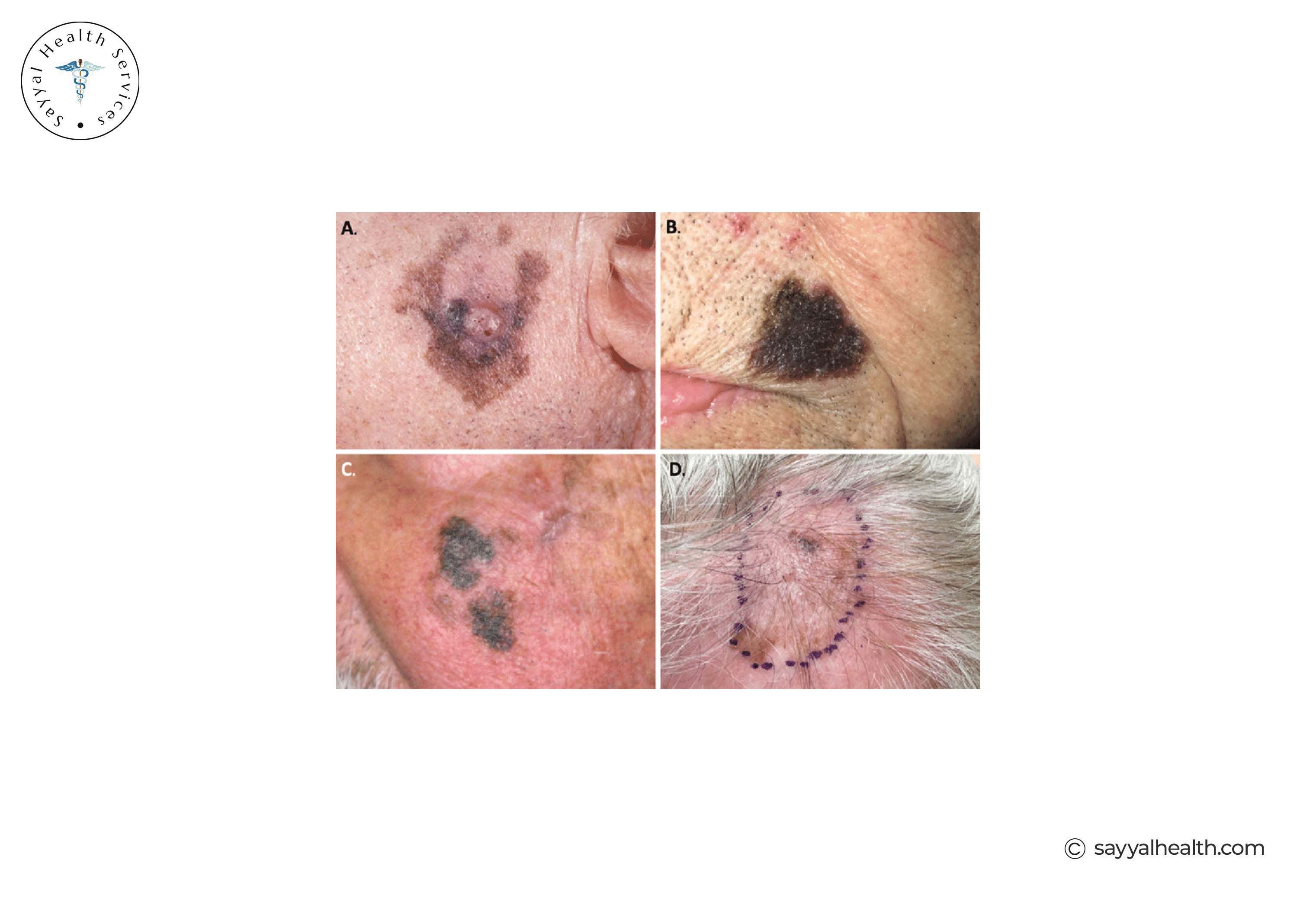 picture of lentigo maligna melanoma on the face
